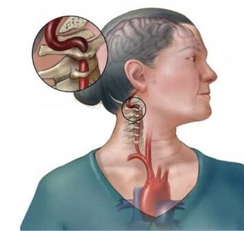 A osteocondrose cervical leva á destrución dos discos intervertebrais da columna vertebral