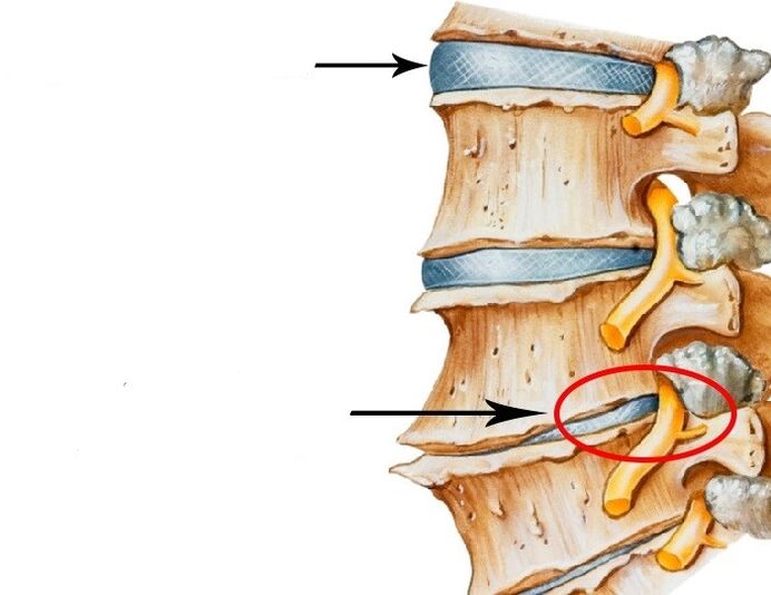 Disco danado e nervio infractor con osteocondrose cervical