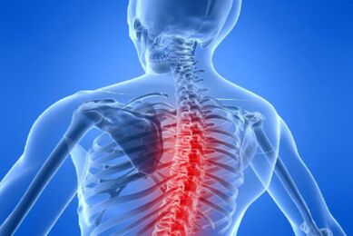 Compresión medular na osteocondrose torácica